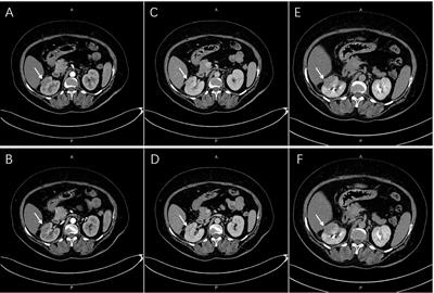 Case Report: Robot-assisted laparoscopic nephron-sparing surgery for a renal abscess mimicking a tumor